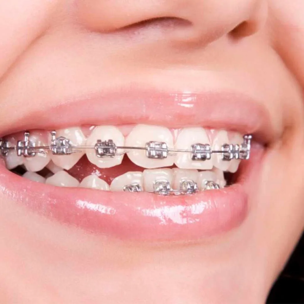 Brackets metalicos sonrisa